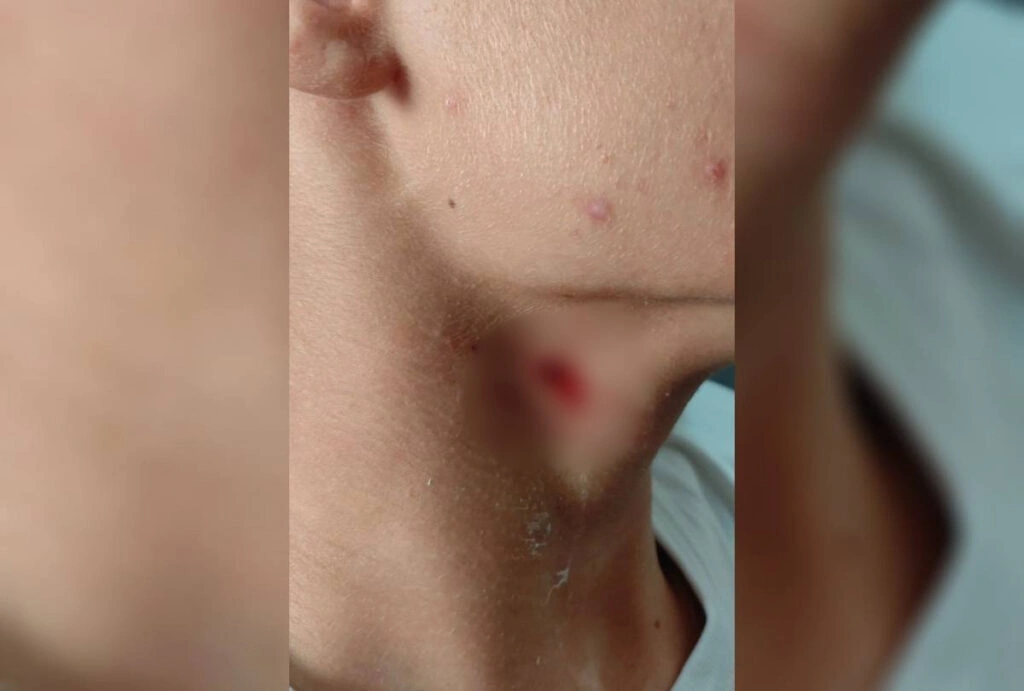 Aluno de 15 anos é apreendido ao cravar caneta no pescoço do colega em colégio no PR