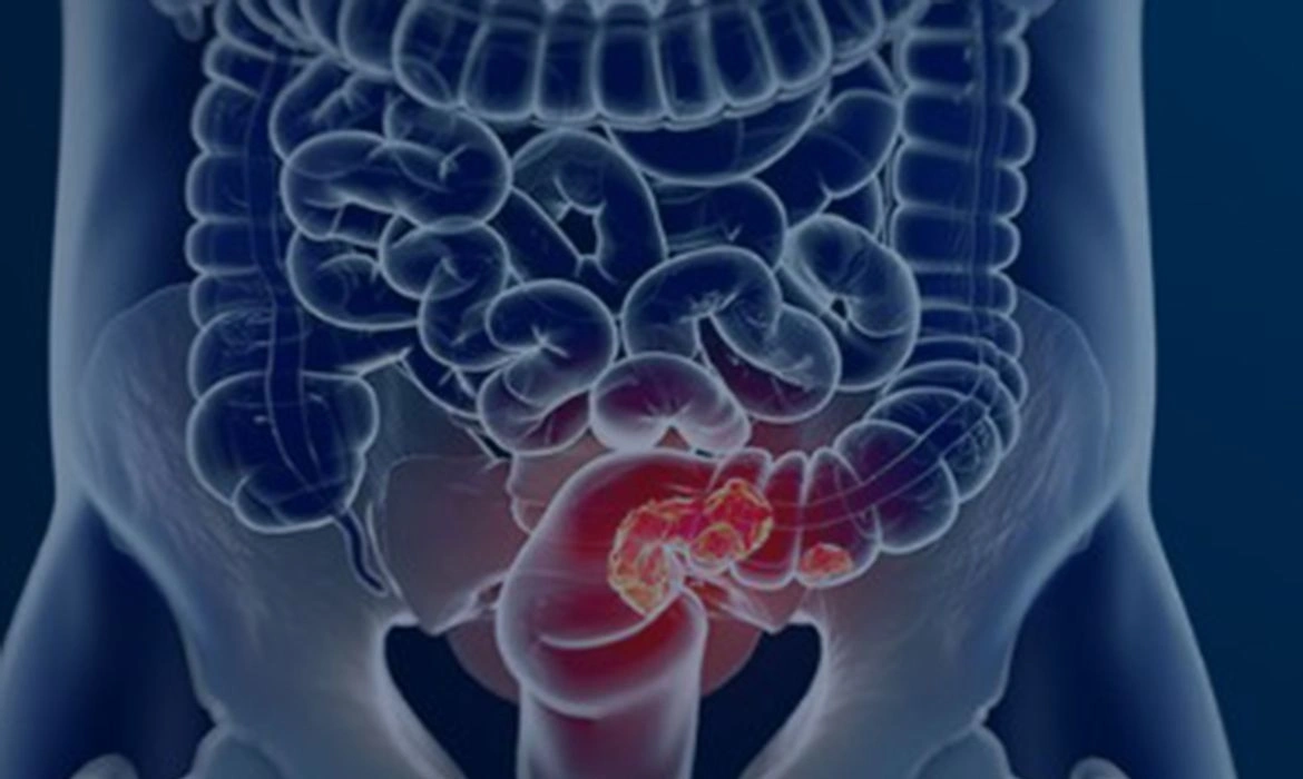 C&acirc;ncer de intestino deve ter 145 novos casos por dia no Brasil em 2026