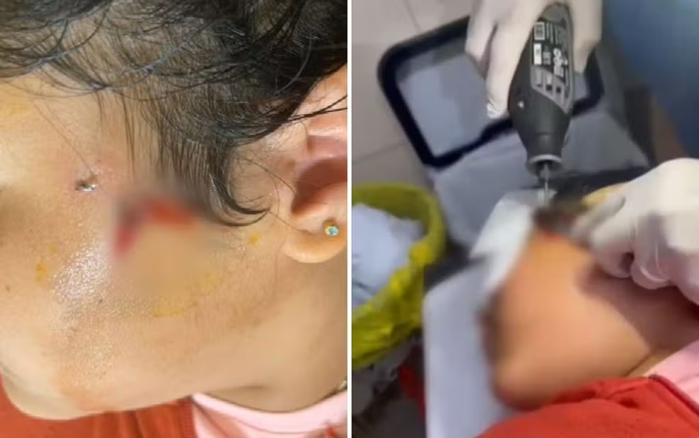 Criança fica com anzol preso no rosto durante pescaria em Goiás